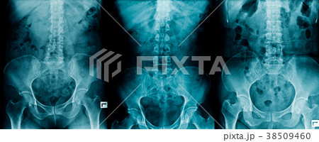 x-ray collection pelvic bone and thraco-lumbar  38509460