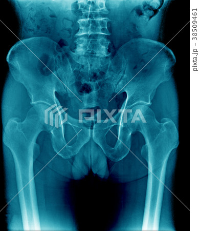 x-ray image pelvic bone and part of femur, spine 38509461