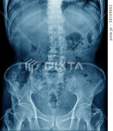 scoliosis  38509662