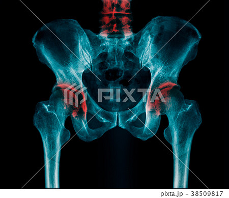 pelvic bone fracture 38509817