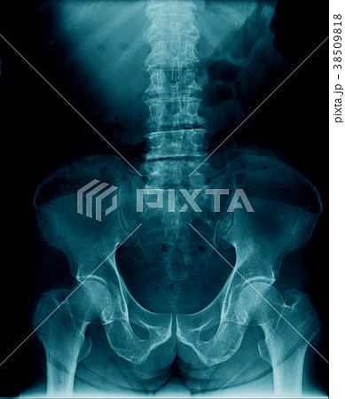 back x-ray 38509818