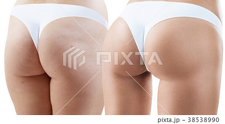 Female buttocks before and after anti-cellulite Female buttocks before and after anti-cellulite 38538990