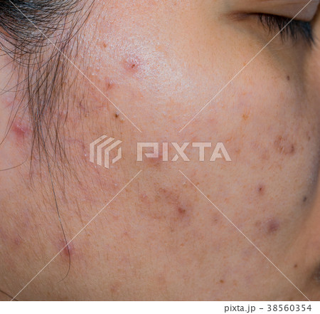 Acne and spot on oily face skin of Asian woman Acne and spot on oily face skin of Asian woman 38560354