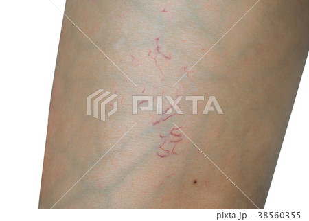 Macro shot of spider veins on woman leg skin  38560355