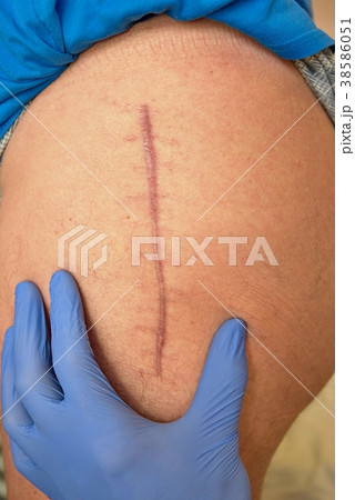 Medicine doctor check scar. Patient  hip joint  38586051
