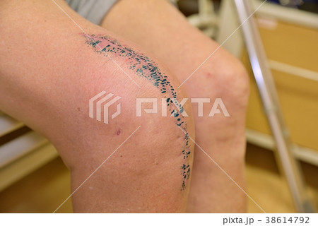 Removed of painful knee joint affected by accident Removed of painful knee joint affected by accident 38614792