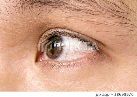 conjunctivitis pupil eye 38698976
