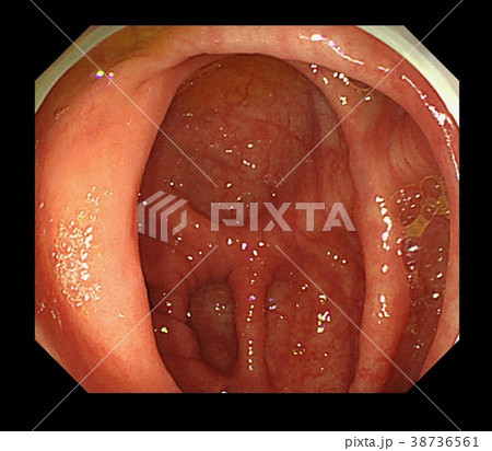 大腸内視鏡　画像 38736561