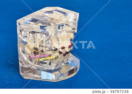 Orthodontic model with implants, dental braces Orthodontic model with implants, dental braces 38767238