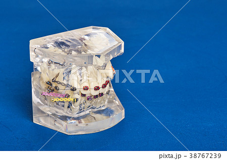 Orthodontic model with implants, dental braces Orthodontic model with implants, dental braces 38767239