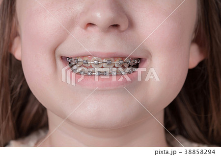 Broad smile girl with metal braces. 38858294