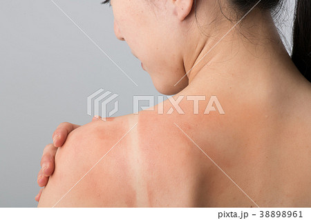 日焼けした若い女性 肩 背中 日焼けした若い女性 肩 背中 38898961