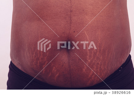 Stomach with stretch marks Stomach with stretch marks 38926616