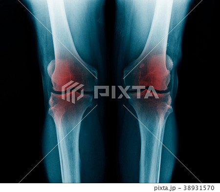 OA knee x-ray 38931570