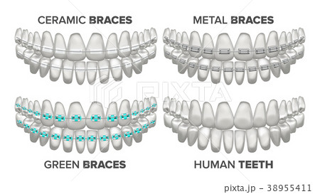 Braces Set Vector. Different Types. Human Jaw 38955411