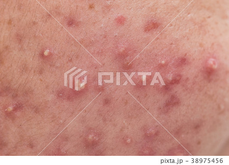 closeup skin problems, nodular cystic acne skin 38975456
