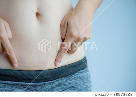 woman showing dark scar from a cesarean section. 38978238