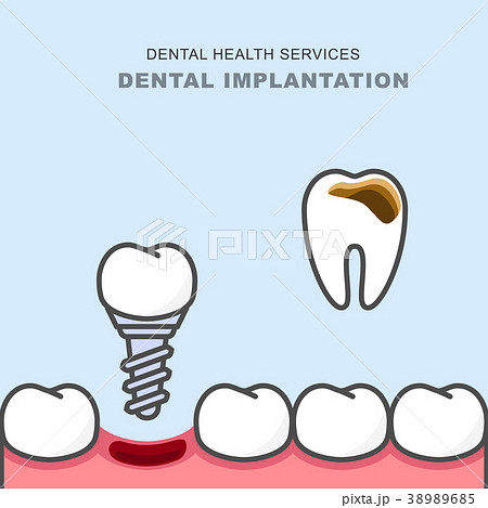 Dental implant instead of carious tooth  38989685