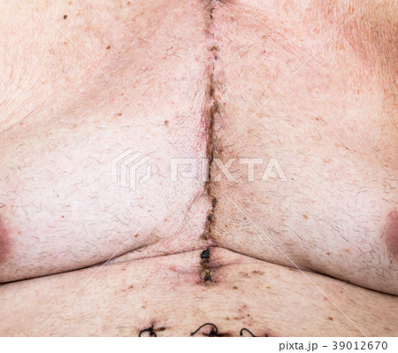Surgical scar from cardiac surgery of coronary artery disease 39012670
