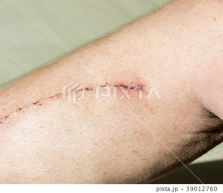 Male leg with scar from cardiac surgery Male leg with scar from cardiac surgery 39012760