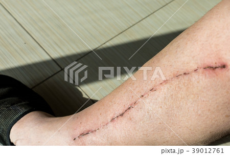 Male leg with scar from cardiac surgery Male leg with scar from cardiac surgery 39012761