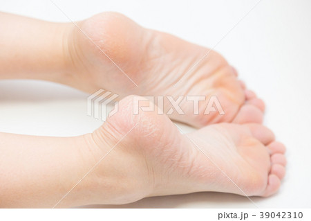 女性のかかとのひび割れ 女性のかかとのひび割れ 39042310