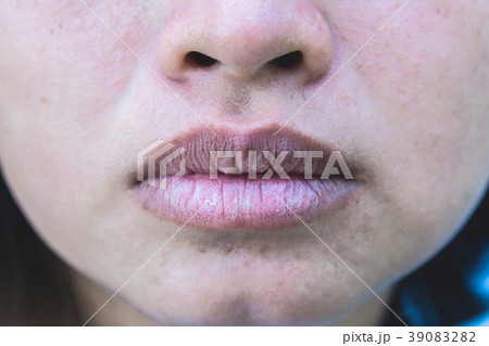 Mouth of asian woman with brittle and dry lips, 39083282