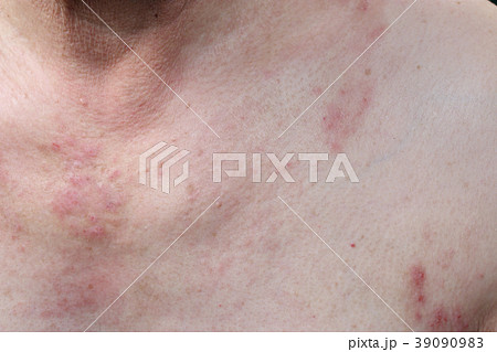 乾燥肌の症状 首から下 39090983