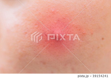 Closeup Big Acne Head skin Inflammation problem 39154241