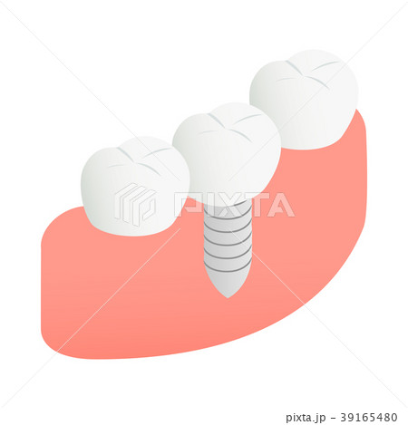 Tooth Implant icon, isometric 3d style 39165480