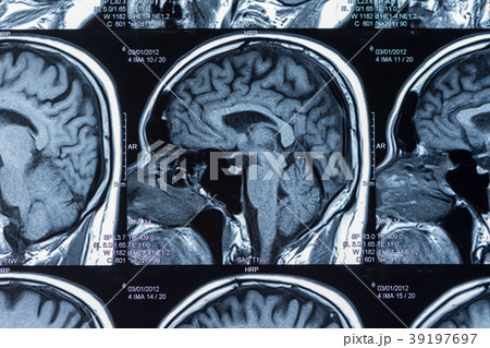 brain mri scan 39197697
