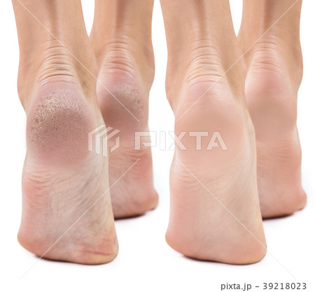 Feet with dry skin before and after treatment. 39218023