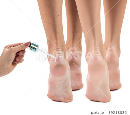 Feet with dry skin before and after treatment. 39218026