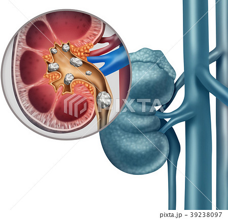 Kidney Stone 39238097