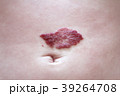 Capillary hemangioma regression. Red birthmark on 39264708