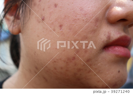 Close up of acne on skin woman Close up of acne on skin woman 39271240