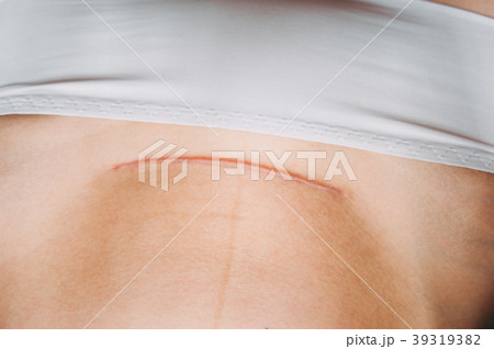 Closeup of woman belly with a scar  39319382