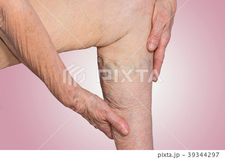The varicose veins on a legs of old woman on 39344297