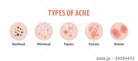 Types of acne diagram illustration vector on white 39394453