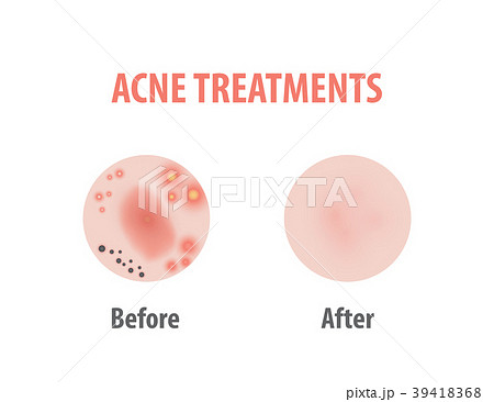 Acne treatments diagram illustration vector Acne treatments diagram illustration vector 39418368