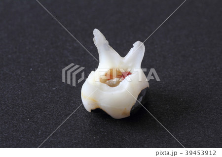 抜け落ちた第一乳臼歯 抜け落ちた第一乳臼歯 39453912