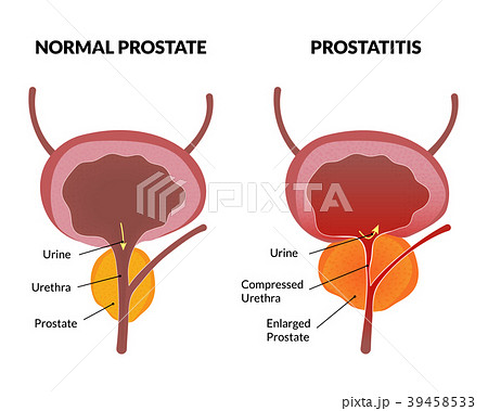 Prostatitis pathology poster Prostatitis pathology poster 39458533