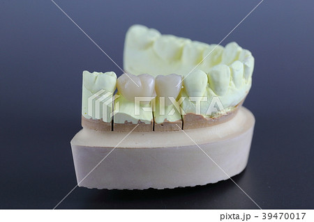 CAD/CAM冠5 CAD/CAM冠5 39470017