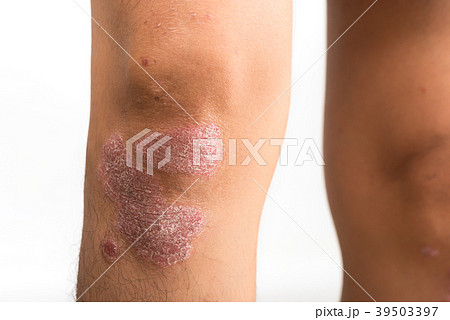 Psoriasis that knee on white background 39503397