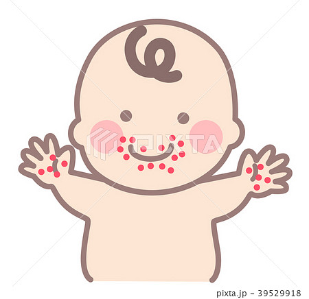 口のまわりと手のひらに湿疹のある赤ちゃんのイラスト素材