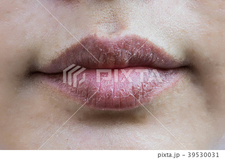 Dry mouth , dry lip Skin peeling 39530031