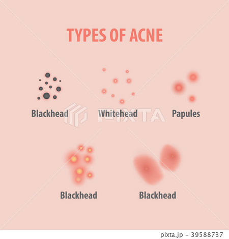 Types of acne illustration vector 39588737