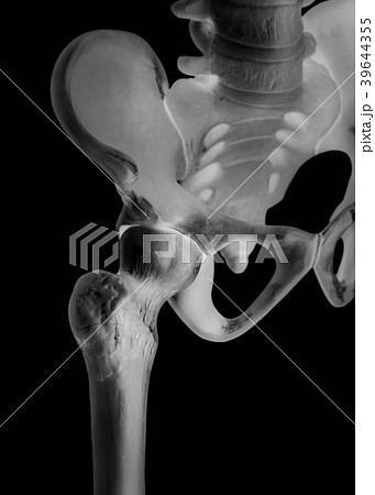Human hip joint, Bone X-ray film, Healthcare Human hip joint, Bone X-ray film, Healthcare 39644355