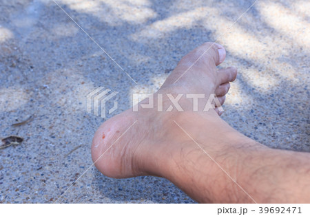 Fungus on foot. Fungus on foot. 39692471