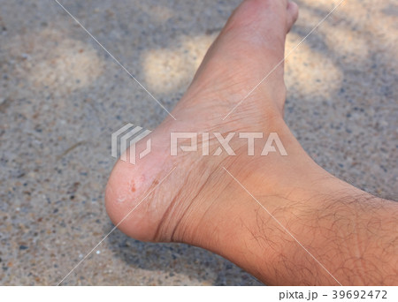 Fungus on foot. 39692472